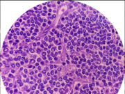 Non-Hodgkins lymfom – när immunsystemet blir fiende Non-Hodgkins lymfom – när immunsystemet blir fiende
