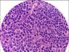Non-Hodgkins lymfom – när immunsystemet blir fiende Non-Hodgkins lymfom – när immunsystemet blir fiende