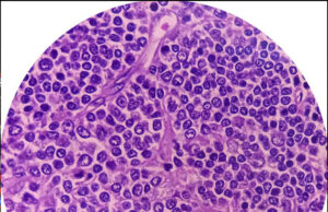 Non-Hodgkins lymfom – när immunsystemet blir fiende Non-Hodgkins lymfom – när immunsystemet blir fiende