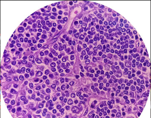 Non-Hodgkins lymfom – när immunsystemet blir fiende Non-Hodgkins lymfom – när immunsystemet blir fiende