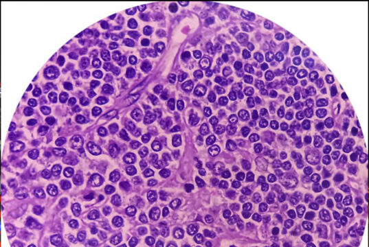 Non-Hodgkins lymfom – när immunsystemet blir fiende Non-Hodgkins lymfom – när immunsystemet blir fiende